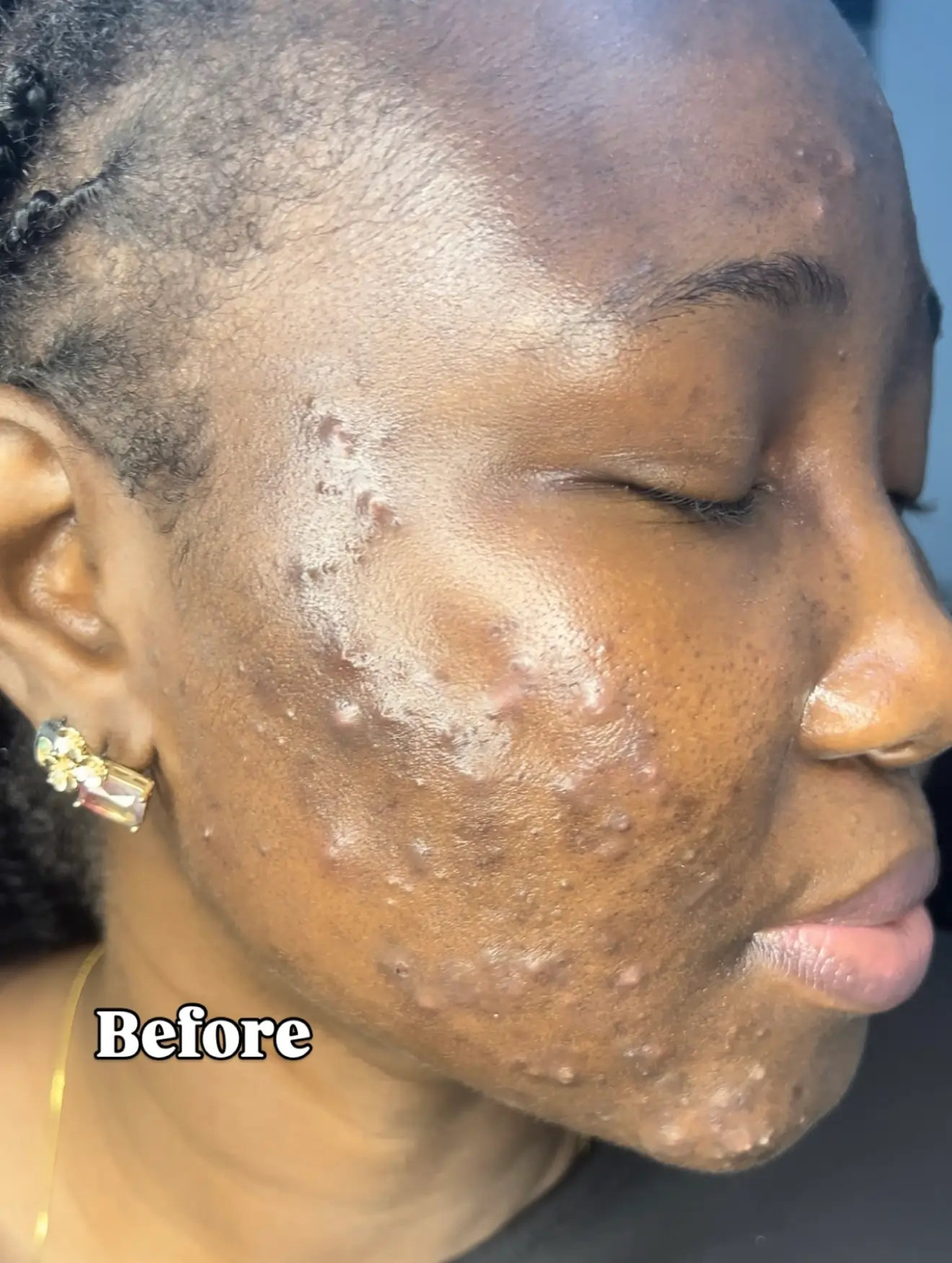 Skin before CYOU — week 0