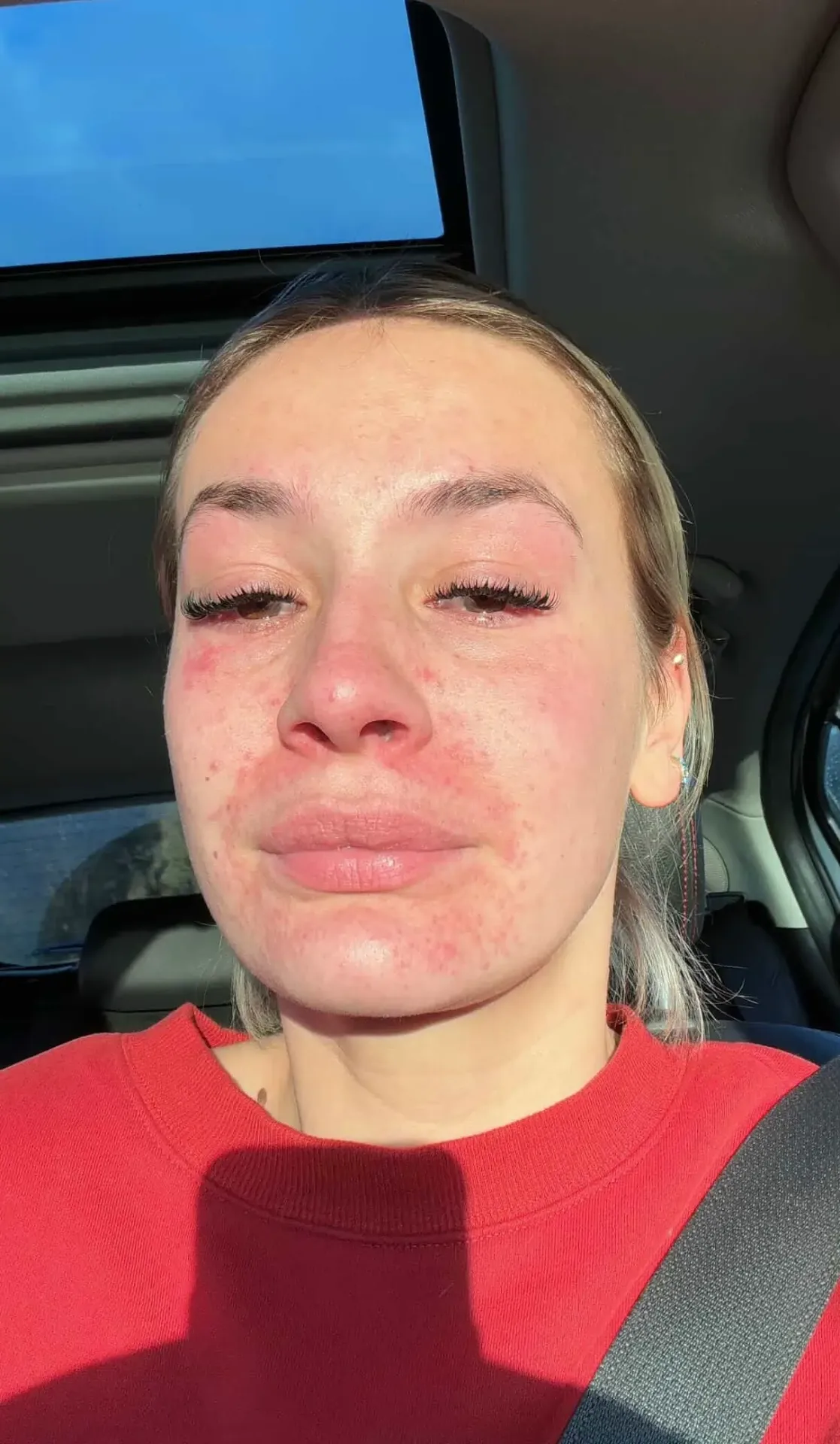 Sarah's skin before CYOU — week 0